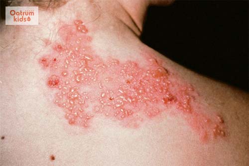  Biểu hiện giai đoạn phá bệnh của zona thần kinh