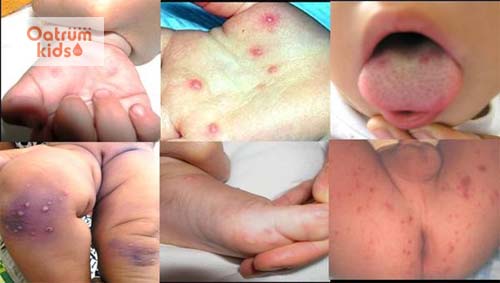  Bệnh tay chân miệng ở trẻ em