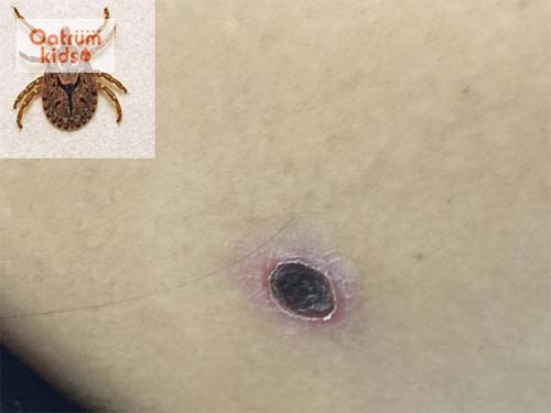 Bệnh sốt mò xuất hiện vết loét ngoài da