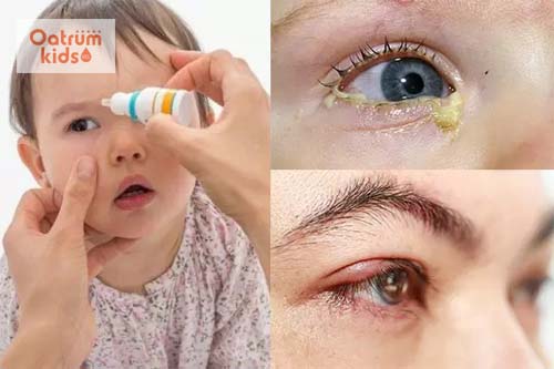  Phát hiện và điều trị kịp thời tránh gây ảnh hưởng đến thị giác của trẻ