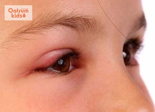  Sưng mí mắt ở trẻ em do rất nhiều nguyên nhân gây nên
