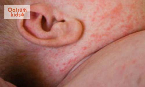  Xuất hiện các nốt ban trên da là dấu hiệu của bệnh sởi