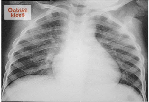  Nếu không được điều trị kịp thời trẻ dễ bị biến chứng đường hô hấp