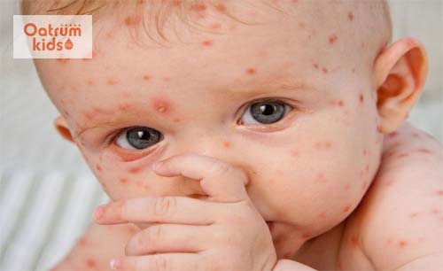  Trẻ dưới 1 tuổi rất dễ bị bệnh sởi