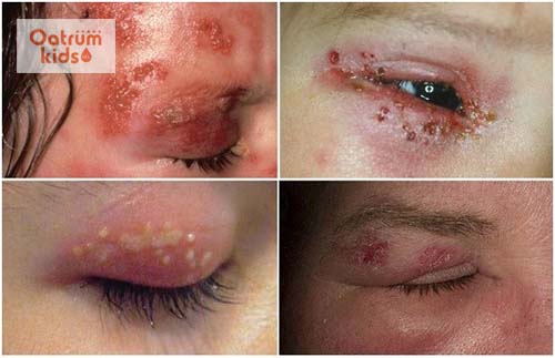  Zona thần kinh ở vùng mắt có thể dẫn đến mù lòa