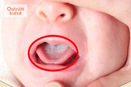 Tưa lưỡi khiến trẻ đau rát, khó chịu