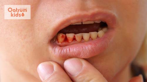  Viêm nướu khiến trẻ bị chảy máu chân răng