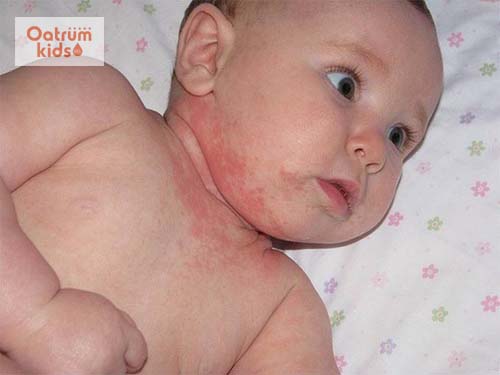  Có nhiều nguyên nhân khiến trẻ bị viêm da dị ứng
