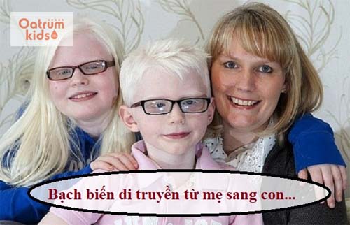 Bố hoặc mẹ bị bạch biến khiến con sinh ra có nguy cơ mắc bệnh bạch biến cao