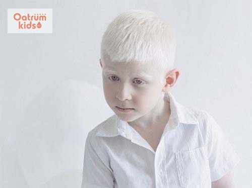 Bệnh bạch biến không nguy hiểm nhưng gây ảnh hưởng đến tâm lý của trẻ