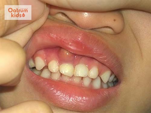 Trẻ bị sưng lợi có mủ