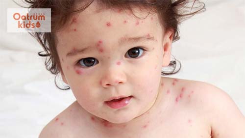  Biểu hiện của bệnh phỏng dạ giai đoạn toàn phát 