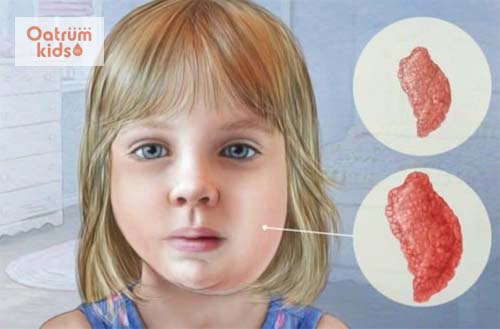  Quai bị ở trẻ em thường gây sưng và đau nhức