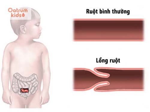  Lồng ruột ở trẻ sơ sinh là bệnh lý ngoại khoa nghiêm trọng