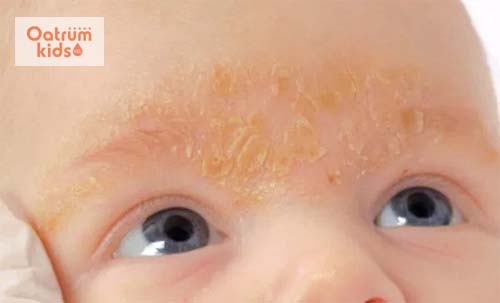  Cứt trâu có thể xuất hiện ở nhiều vị trí trên cơ thể