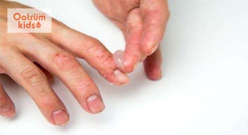  Sử dụng thuốc bôi corticoid cần có sự chỉ định của bác sĩ