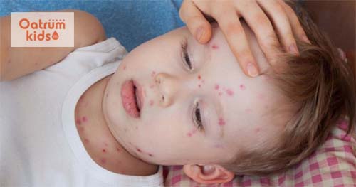  Bị thủy đậu cần ở nơi thoáng mát có nhiệt độ thích hợp không cần chánh gió