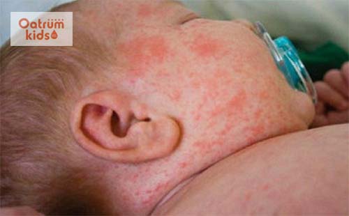  Sốt phát ban ở trẻ sơ sinh đặc trưng bởi những ban đỏ sau khi hạ sốt