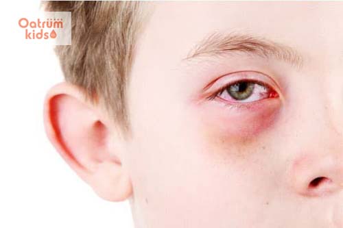 Áp dụng chế độ ăn uống sai lầm có thể khiến cho bệnh đau mắt đỏ của bé trở nên nghiêm trọng hơn