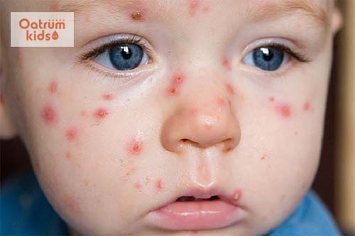  Những mụn nước nhiều độ tuổi trên mặt trẻ sơ sinh