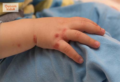  Trẻ bị tay chân miệng bao lây thì khỏi