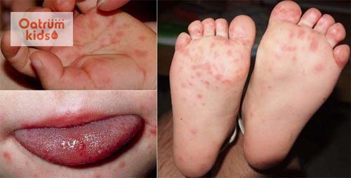  Triệu chứng bệnh tay chân miệng