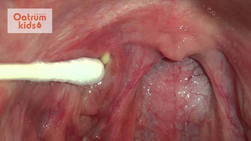  Khi mắc sỏi amidan trẻ cũng có đốm trắng trên vòm họng