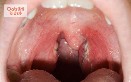  Viêm họng đặc hiệu là nguyên nhân cho những đốm trắng trên vòm họng của bé