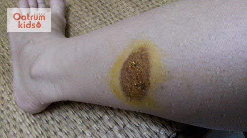  Điều trị sai cách là nguyên nhân khiến bỏng bô xe máy để lại sẹo