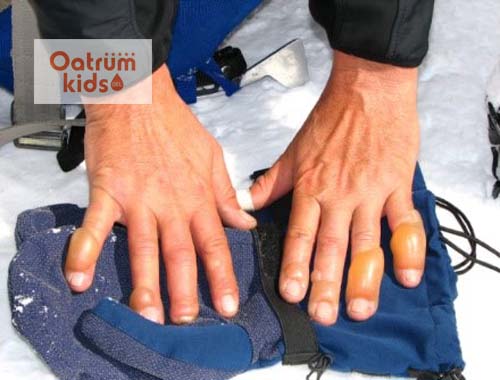  Bỏng lạnh gây nguy hiểm tới tính mạng nếu không kịp thời sơ cứu và điều trị