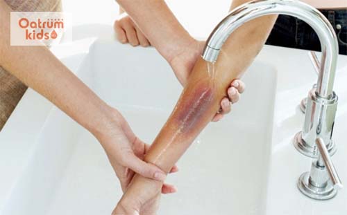  Dùng nước mát xối vào vết bỏng trong 15 phút giúp hạ nhiệt, giảm đau rát