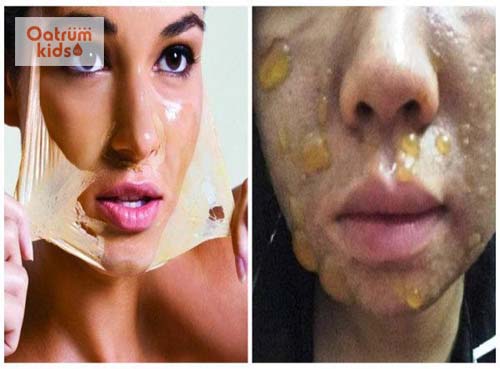  Bỏng da mặt gây nên những tổn thương nặng nề