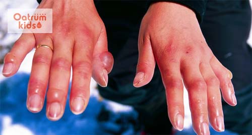  Bỏng lạnh rất nguy hiểm nếu không được xử trí và điều trị kịp thời