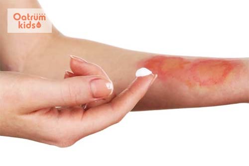  Các loại thuốc bôi trị bỏng cần được bác sĩ chỉ định điều trị