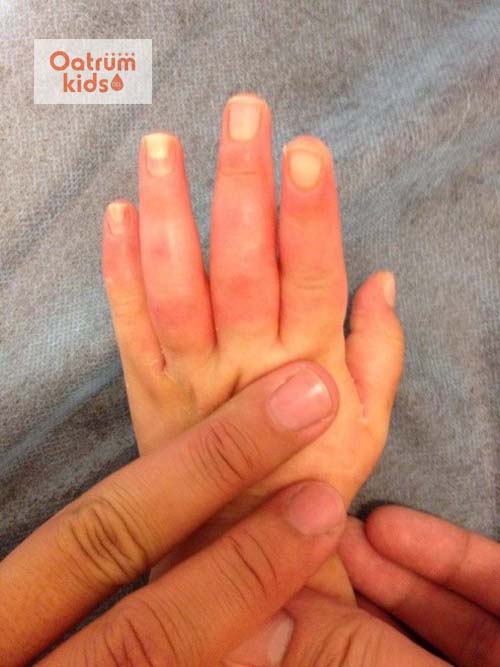  Bỏng nước sôi rất thường gặp ở trẻ