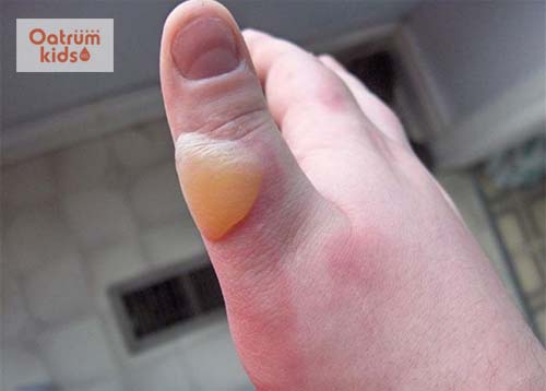  Bỏng phồng rộp da do nước sôi hoặc dầu mỡ, bỏng nắng