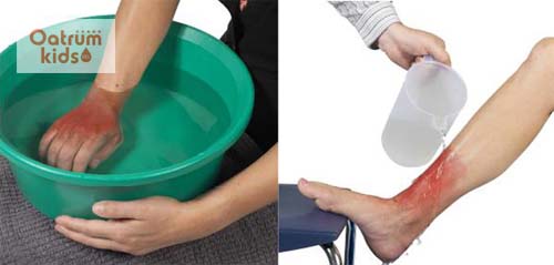  Ngâm nước mát giúp vết bỏng dịu đi cảm giác đau rát
