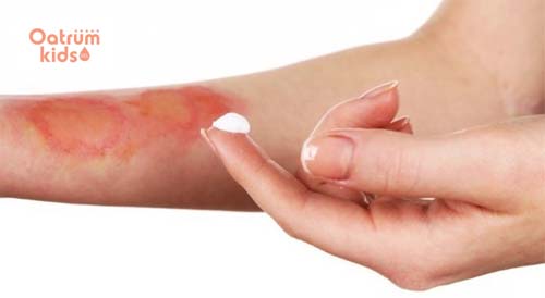  Thuốc trị bỏng cần có tác dụng chống viêm, kháng khuẩn, giảm đau và ngăn ngừa để lại sẹo