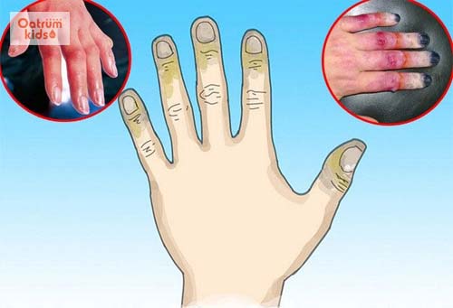  Bỏng lạnh xảy ra khi tiếp xúc với nhiệt độ quá thấp