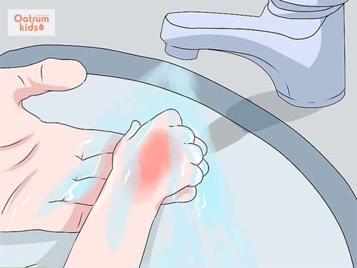  Làm mát vết bỏng giúp trẻ giảm đau, giảm phù nề, viêm nhiễm