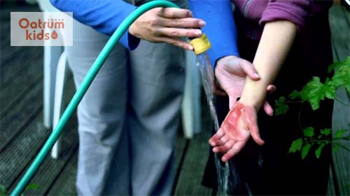  Hạ nhiệt cho vết bỏng là việc đầu tiên cần làm