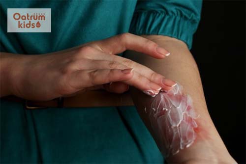  Chữa bỏng nhiệt đúng cách giúp hạn chế biến chứng và rút ngắn thời gian điều trị