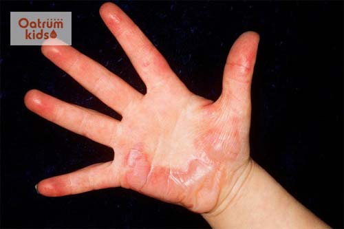  Bỏng lạnh có thể “giết” bạn từ từ và đau đớn