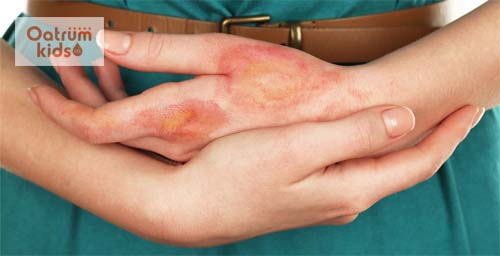  Bỏng nước sôi có thể để lại nhiều di chứng nguy hiểm nếu không điều trị đúng cách