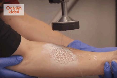  Sơ cứu bỏng hóa chất đúng cách làm giảm mức độ nghiêm trọng