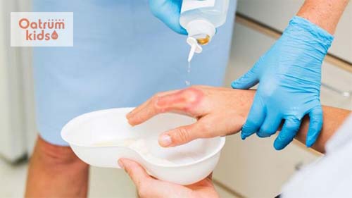  Làm sạch vết bỏng bô bằng nước muối sinh lý hoặc dung dịch Providine 10%