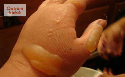 Trẻ càng bỏng nặng càng dễ bị bội nhiễm