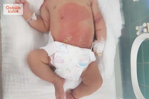 Trẻ bị bỏng độ 3 cần được đưa đi cứu chữa kịp thời