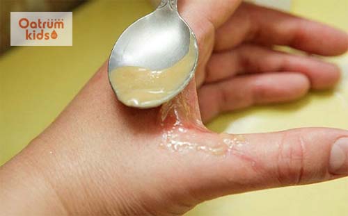 Tuyệt đối không tự ý bôi thuốc lên vết bỏng của trẻ