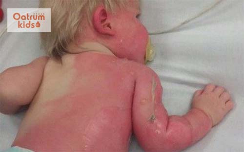 Bỏng nước sôi ngày càng phổ biến ở trẻ